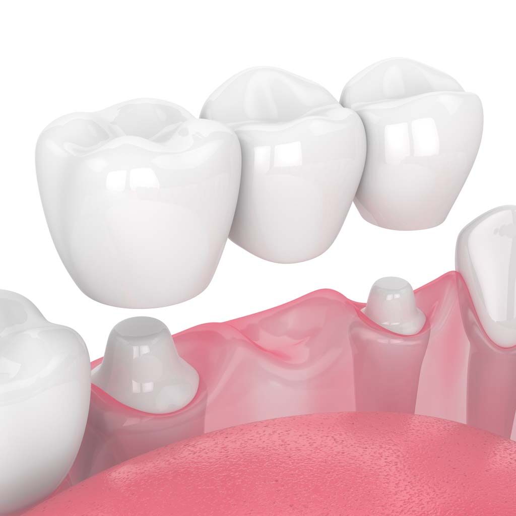 Illustration of bridge cap on set of teeth