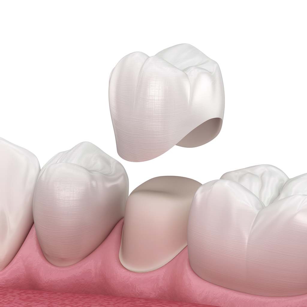 Illustration of crown on set of teeth