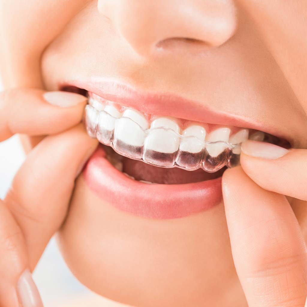 invisalign clear braces being placed on teeth