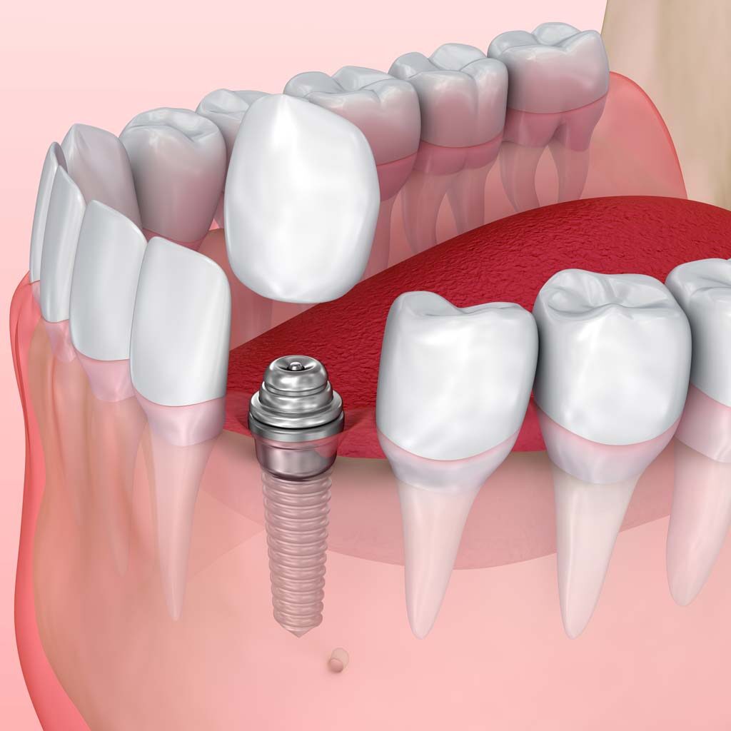 Illustration of tooth implant on set of teeth